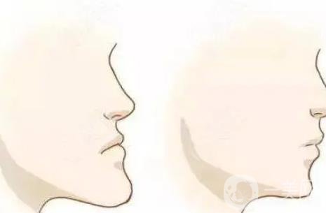 凸嘴手術多久恢復