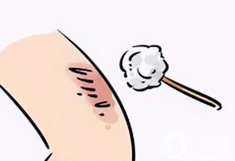 激光祛疤術(shù)后護理