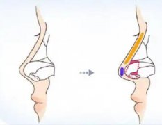 鼻小柱延長后會不會塌陷？哪些人群適合鼻小柱延長術(shù)？