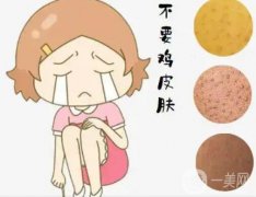 激光可以去除雞皮嗎？雞皮去除有哪些注意事項(xiàng)