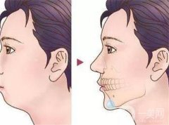 墊下巴后多久可以刷牙？需要多久才能恢復(fù)？