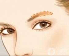 眉弓微整的優(yōu)缺點(diǎn)？眉弓微整前有哪些準(zhǔn)備？