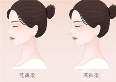 墊鼻梁價(jià)格的影響因素是哪些？?jī)r(jià)格是多少？