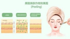 果酸換膚有哪些術(shù)前準(zhǔn)備？術(shù)后如何護(hù)理？