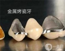 如何解決烤瓷牙的疼痛？烤瓷牙疼應(yīng)該掛什么科？