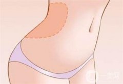 冷凍溶脂有嗎？適合腰腹減肥嗎？