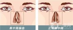 哪些因素影響鼻中隔偏曲矯正的價(jià)格？