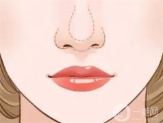 鼻頭縮小的優(yōu)勢(shì)有哪些？會(huì)反彈嗎