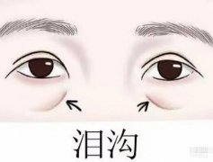 填充淚溝嗎?有風(fēng)險(xiǎn)嗎?什么會(huì)影響價(jià)格