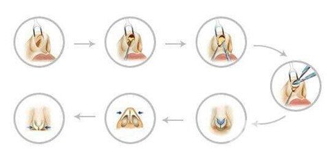 徐州二院整形美容科價(jià)格表，附隆鼻整形案例
