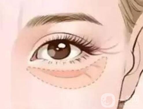 疤痕體質(zhì)去眼袋方法 疤痕體質(zhì)怎么去眼袋？