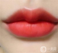 哪些人適合玻尿酸隆唇？多長時間可以軟化呢