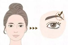 切眉有副作用嗎？很容易感染嗎