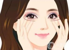 雙眼皮有哪些形狀?如何避免割雙眼皮的失敗?