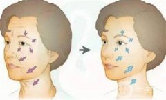 全臉脂肪填充怎么樣？優(yōu)勢有哪些？哪些人又不能做呢