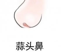 怎么矯正大蒜鼻？如何不手術(shù)改良大蒜鼻？