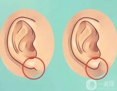 豐耳垂的方法有哪些？