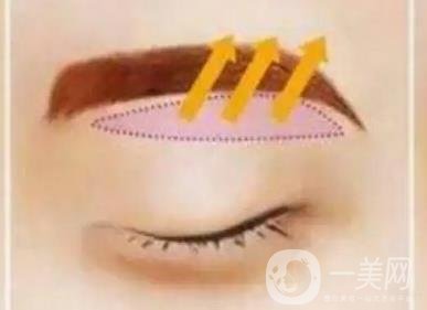 上海假體豐眉弓價(jià)格 豐眉弓材料有哪些