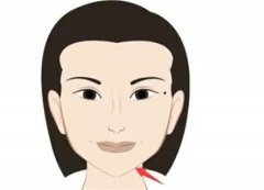 墊下巴的果是*的嗎？多長時(shí)間可以消腫