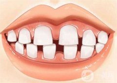 地包天是怎么形成的？地包天可以矯正嗎