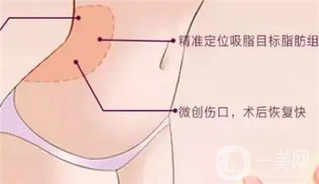 全身吸脂手術(shù)價(jià)格？馮斌做全身吸脂大概多少錢？