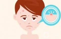 激光調(diào)節(jié)痤瘡有副作用嗎？