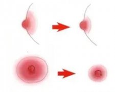 乳暈縮小術(shù)的方法？對母乳喂養(yǎng)有影響嗎？
