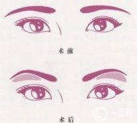 切眉后眼睛變形了怎么辦？浮腫怎么辦？