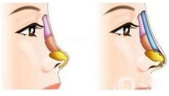為什么耳軟骨墊鼻尖會(huì)歪斜？耳軟骨墊鼻尖后歪斜怎么辦？