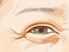 激光去魚尾紋術(shù)前術(shù)后的注意事項