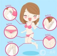 超冰點脫毛的副作用有哪些？