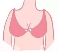 假體隆胸失敗有什么癥狀？隆胸后需要臥床多久？