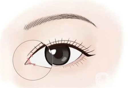 開眼角的危害是什么？如何開眼角的*