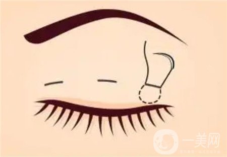 濟(jì)南隅美整形醫(yī)院怎么樣?雙眼皮真實(shí)案例和價(jià)格表一覽