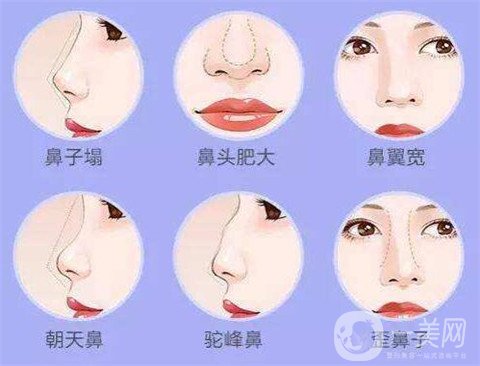 湖南省人民醫(yī)院整形美容科隆鼻*果如何？看價格表及案例實述