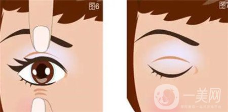 山東省立醫(yī)院開眼角多少錢?附2020整形價格表及案例