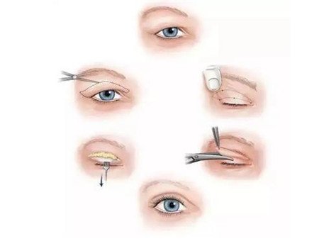 山東省立醫(yī)院開眼角多少錢?附2020整形價格表及案例