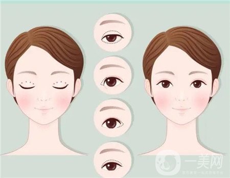 咸陽二院美容科雙眼皮多少錢?案例及價格表一覽