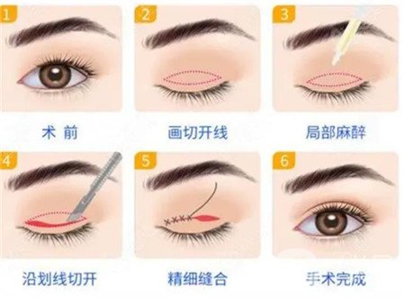 益陽市中心醫(yī)院整形美容科價格表完整版及雙眼皮修復(fù)案例瀏覽