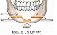什么是切骨？需要多少費用？