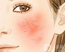 激光去除紅血絲有哪些好處？