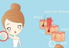 激光脫毛有哪些特點？什么是光子脫毛？
