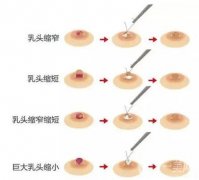 乳頭凹陷的種類以及原因有哪些?