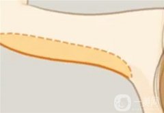 什么因素決定手臂吸脂的價格？