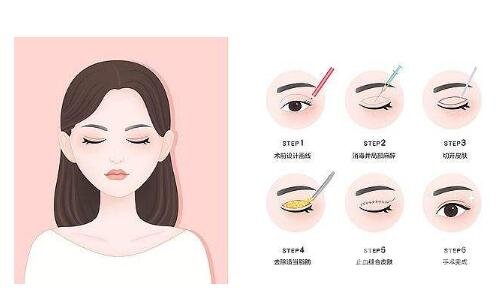 激光去黑眼圈*嗎 激光黑眼圈*果咋樣