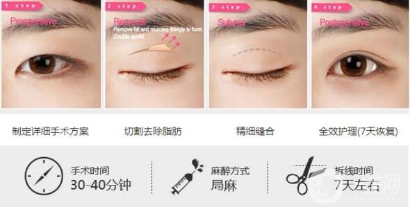 迪麗熱巴雙眼皮