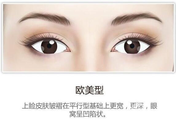 開眼角后疤痕增生怎么辦？