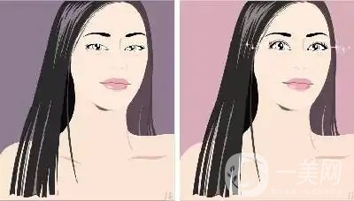 開眼角,上海開眼角價錢,開眼角注意事項