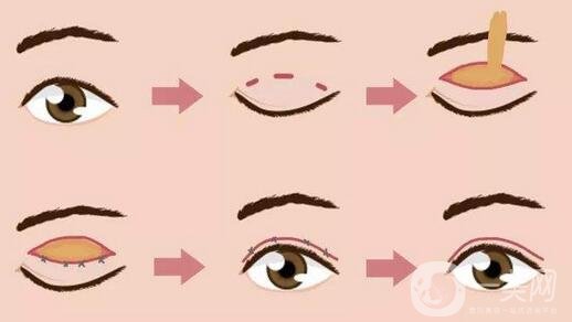 北京埋線雙眼皮修復(fù)價格盤點