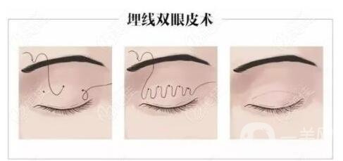 成都割雙眼皮價(jià)格